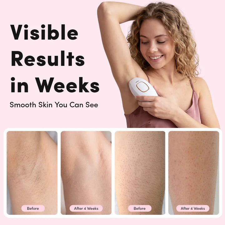 IPL Hair Removal Device for Home Use - Painless Hair Removal