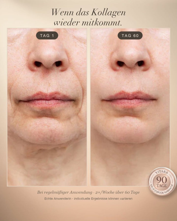 Anti-Wrinkle Starter Set - VITARA Micro-Needling Infusion for Home Use